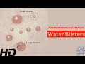 Water Blisters Unveiled: Causes, Treatment, and Prevention