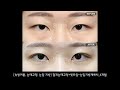 무보정전후영상 속쌍꺼풀 눈매교정 눈밑 지방｜절개눈매교정 윗트임 눈밑지방재배치_4개월｜시선성형외과