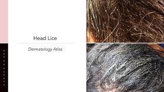 Head Lice