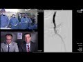 ostial sfa cto intervention april 22 2019