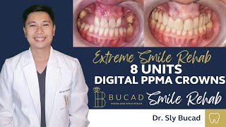 MOST BUDGET DIGITAL CROWNS 8 UNITS PMMA CROWNS