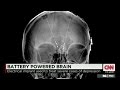 Deep brain stimulation treats depression