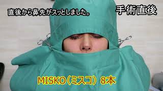 切らずに簡単鼻先延長MISKO8本術中動画171216