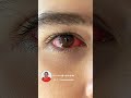 కళ్ళు ఎర్రగా ఉంటున్నాయా how to turn red eyes white naturally dr.l.umaa venkatesh