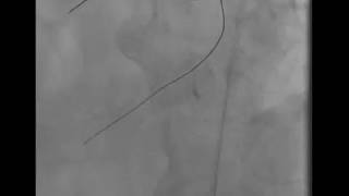 PCI to CTO LCX using microcatheter assisted antegrade wire escalation (Case 4)