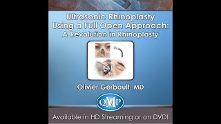 Ultrasonic Rhinoplasty using a full open approach: A revolution in rhinoplasty