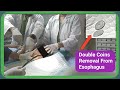 Swallowed Coin Removal From Esophagus #BD_ENDOSCOPY