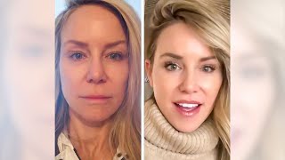 How this 58 year old looks like she is 30! Two Year Facelift and Lip Lift transformation #shorts
