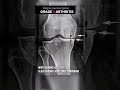 Knee Arthritis: Mild to Severe to NEW #shorts