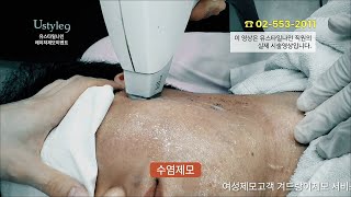 수염레이저제모통증 궁금하셨죠?