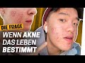 Akne: Mehr als nur Pickel | Wie komme ich mit meinem Körper klar? Folge 5