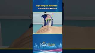 Cryoablation Unique Treatment Characteristics