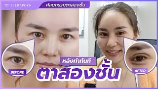 หลังทำตาทันที เพื่อนว่าดีเลยทำตาม ธีรพรคลินิก หมอชลธิศ