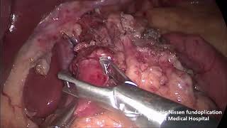 Laparoscopic Nissen  fundoplication