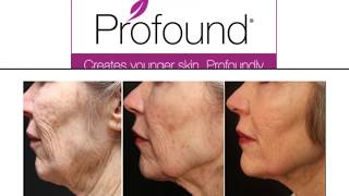 Now Introducing Profound "Non-Surgical Face Lift"