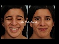 Rhinoplastie ultrasonique 👃 Ultrasonic rhinoplasty