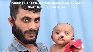 Bilateral Cleft Lip with Nose Correction Surgery | Best Cleft Lip Surgery in Kerala | Cleaning Video