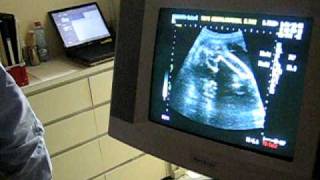 Seventh ultrasound, 18 April 2009