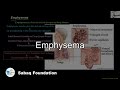 Emphysema, Biology Lecture | Sabaq.pk