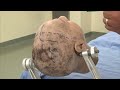 Skull Clamp Placement: Frontal Craniotomy-Incision (Preview)