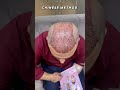 Chinese Method. 8,000 Grafts before & after result of hair transplant 😎👍