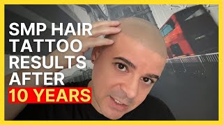 HEALED Scalp Micropigmentation After 10 YEARS! | Hair Tattoo Results