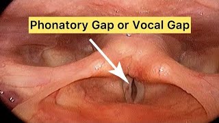 Vocal Gap | Hoarseness of voice |