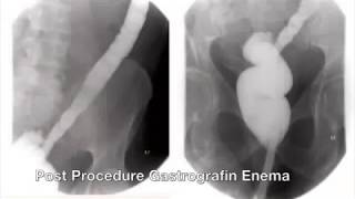 Combined Laparoscopic and Transanal Minimally Invasive Management of an Anastomotic Stricture