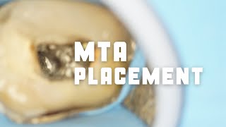 MTA placement in root canals | MTA apexification