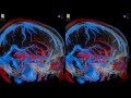 Arteriovenous Malformation (AVM) - 3D Virtual Tour | UCLA Neurosurgery