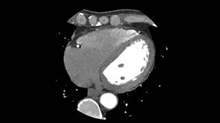 پشکنینی خوێنبەرەکانی دڵ بە بەکارهێنانی ئامێری تیشکی سی تی CT scan