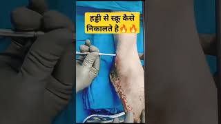 हड्डी Bone से Screw निकाल दिया 🔥🔥| #fracture #fracturerecovery #bonepain #fractures #orthopedics