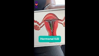 Hormonal IUDs - Dr Eileen Sables