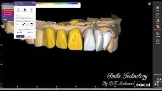 Free form 6 unit anterior teeth Dental design By Exocad