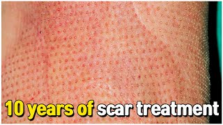 35 years old burn scar