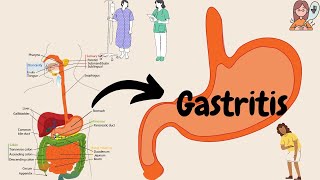 Acute Gastritis (Stomach Inflammation) | Causes, Signs & Symptoms, Diagnosis, Treatment