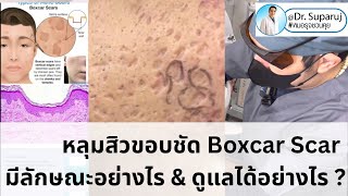 Boxcar scar หลุมสิวขอบชัดแบบกล่องมีลักษณะอย่างไร ดูแลได้อย่างไร รักษาหลุมสิว หมอรุจชวนคุย Picosecond