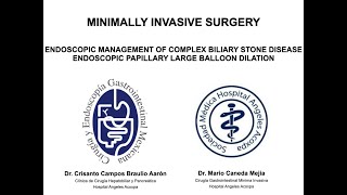 Endoscopic Management of Complex Biliary Stone Disease. Endoscopic Papillary Large Ballon Dilation.