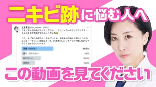 《ニキビ跡に悩む人へ》この動画を見てください！