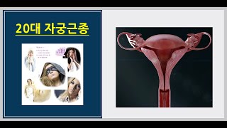 20대자궁근종방치는 금물{김택박사,경희기린한의원)