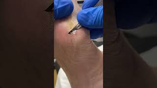 Witness the art of bunion callus removal by top Aussie Podiatrist! #Footcare #PodiatryInAction