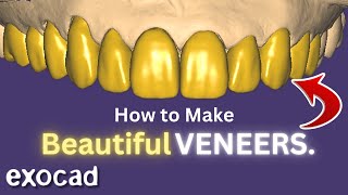 Big VENEER Case. 2024 EXOCAD Tutorial