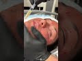 ASTOUNDING ACNE SCAR COMBO #shortsvideo #losangeles #reels #acnescars #acne #doctor #dermatology