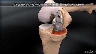 Unicondylar Knee Resurfacing with the iBalance® UKA System