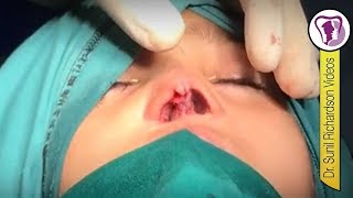 Nose surgery for a small girl with blocked and bent nose - Rhinoplasty by Dr Sunil Richardson