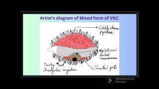 VERNAL KERATO CONJUNCTIVITIS |  VKC  |  SPRING CATARRH  |  WARM WEATHER CONJUNCTIVITIS