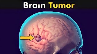 What Happens in Brain Tumor? | Symptoms and Causes (3D Animation) Hindi/Urdu