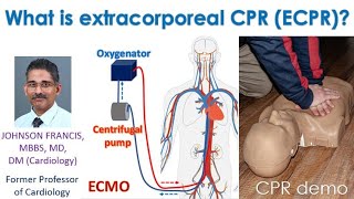 What is extracorporeal CPR ECPR?