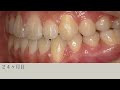 受け口（反対咬合）を抜歯や手術せずに矯正　opposite occlusion without tooth extraction or surgery