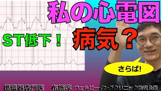 おいらは心臓病なのか？運動時の心電図でST低下！ST低下って、心臓の血管＝冠動脈に狭窄があって心臓の血のめぐりが悪い人、狭心症の人にみられることが多い所見なのです！